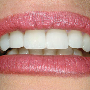 Cosmetic Dentistry Somerset NJ