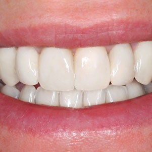 Cosmetic Dentistry Somerset NJ